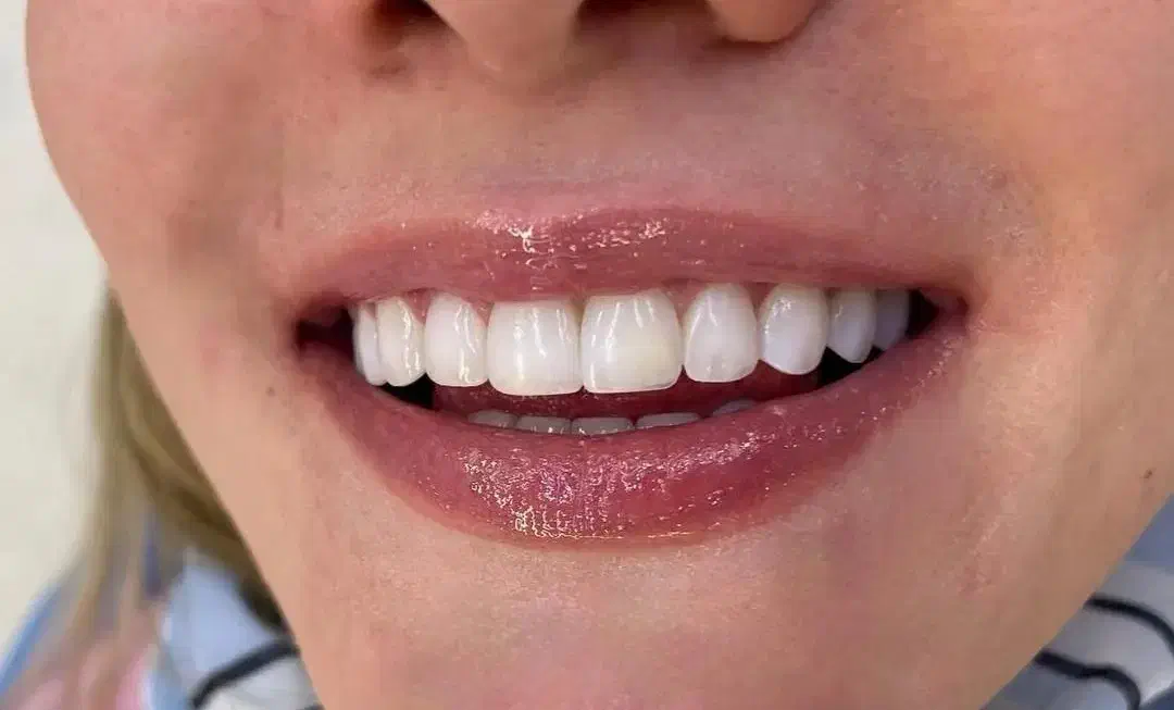 کامپوزیت زیبایی دندان(شهرستان بناب)|خدمات آرایشگری و زیبایی|میاندوآب, |دیوار