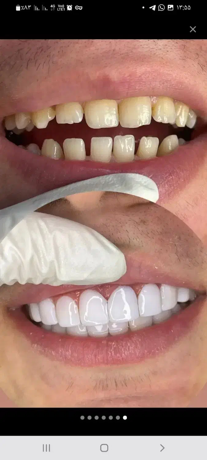 جشنواره کامپوزیت دندان|خدمات آرایشگری و زیبایی|شاهرود, |دیوار