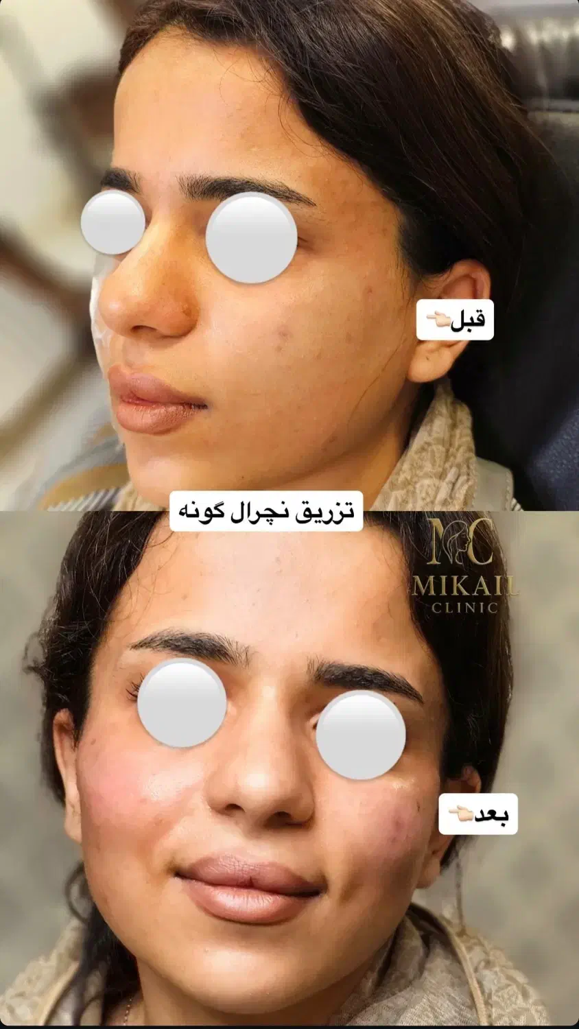 بوتاکس و ژل(فیلر)،بدون درد با ماندگاری بالا|خدمات آرایشگری و زیبایی|ارومیه, |دیوار