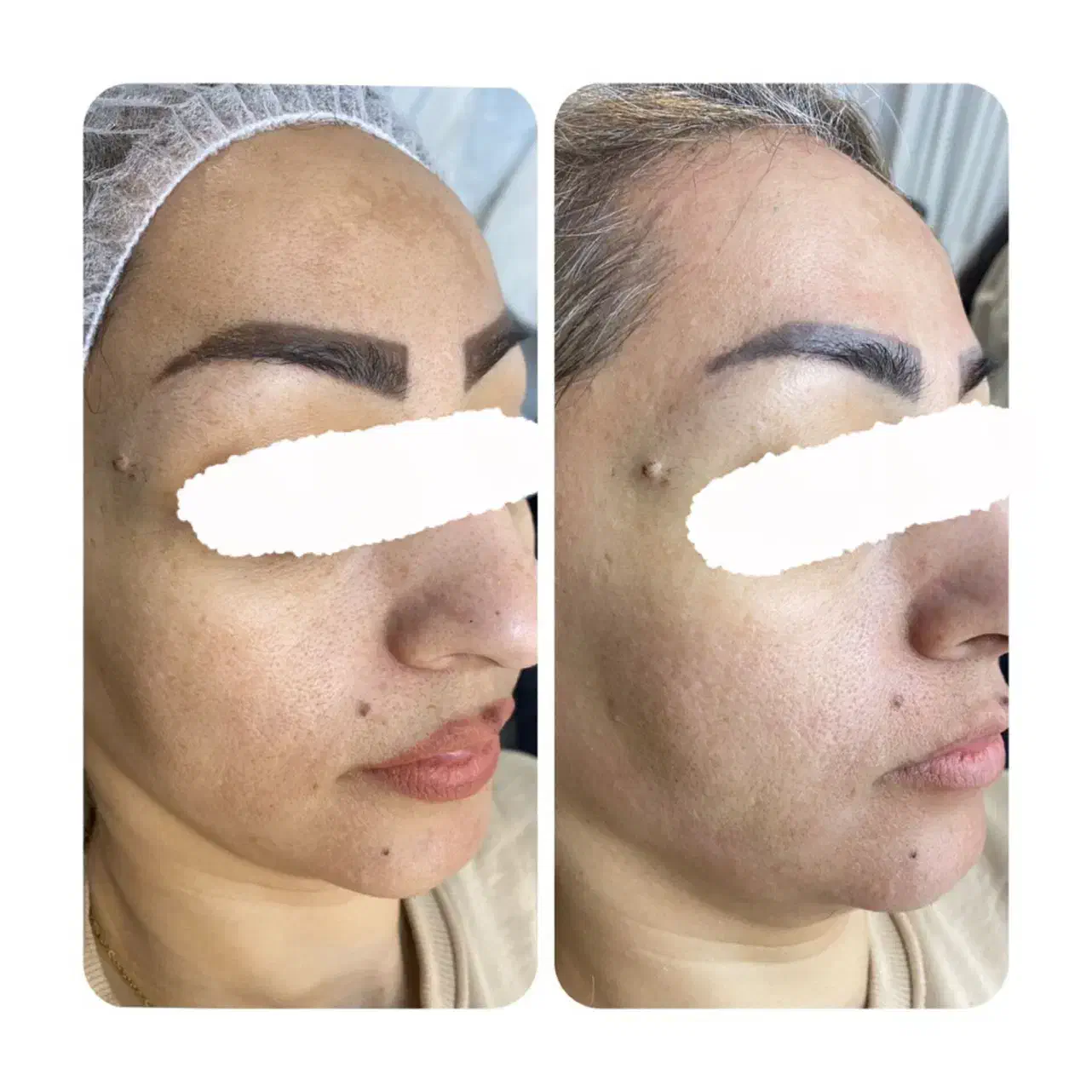 پاکسازی و فیشال پوست|خدمات آرایشگری و زیبایی|مشهد, امام رضا (ع)|دیوار