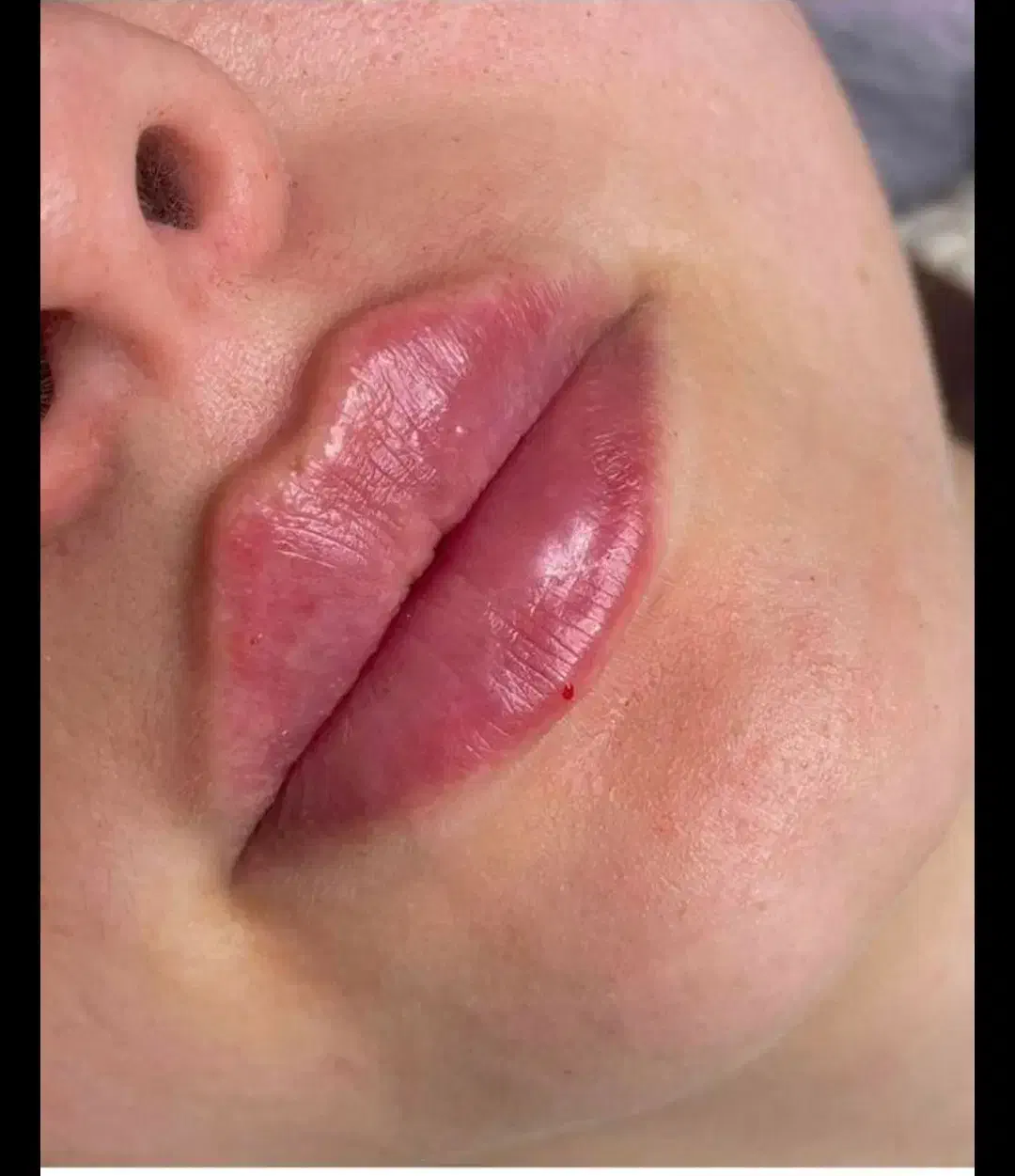 تزریق ژل و بوتاکس با مواد اصل و اورجینال|خدمات آرایشگری و زیبایی|ساری, |دیوار