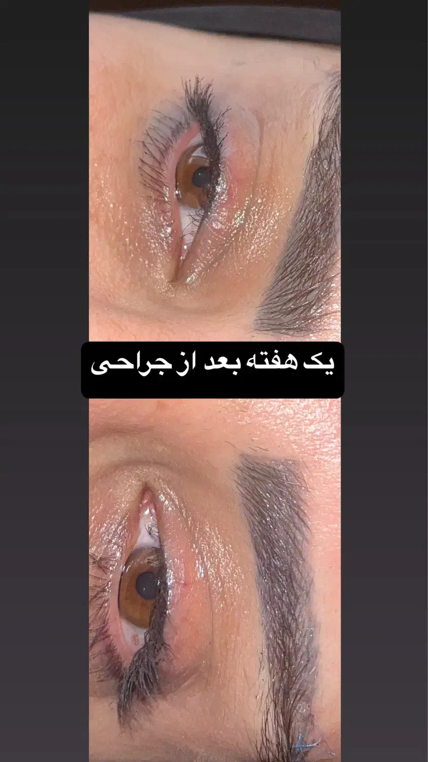 بلفاروپلاستی پلک با روش لیزری بدون رد بخیه|خدمات آرایشگری و زیبایی|تهران, پاسداران|دیوار