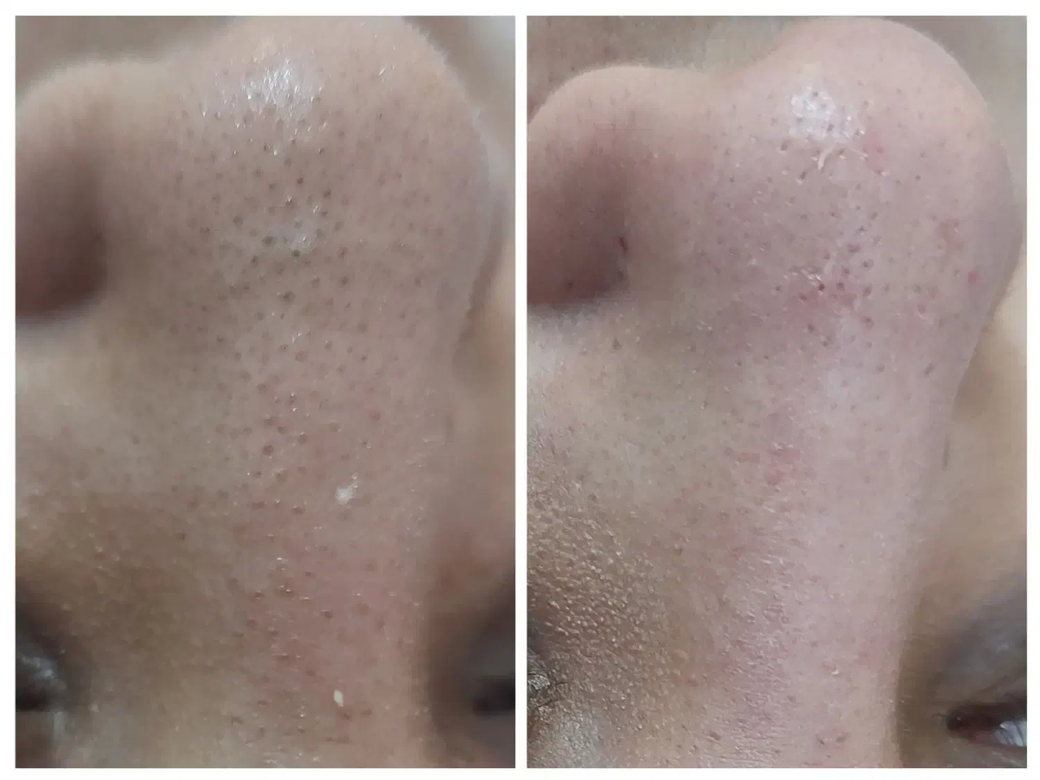 پاکسازی تخصصی صورت|خدمات آرایشگری و زیبایی|محمدشهر, محمدشهر|دیوار