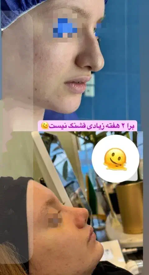 جشنواه ویژه  خدمات   عمل بینی لیپو ساکشن|خدمات آرایشگری و زیبایی|اهواز, کیانپارس |دیوار