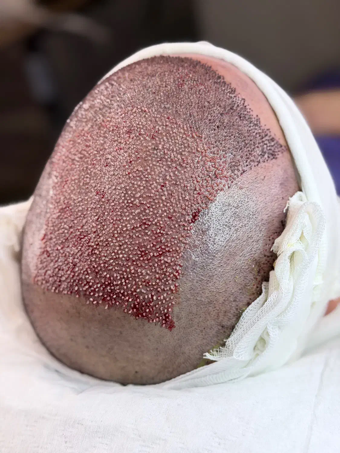 کاشت مو ی پر تراکم|خدمات آرایشگری و زیبایی|ساری, |دیوار