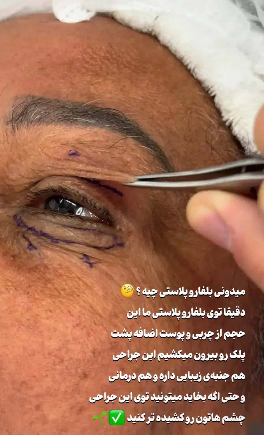بلفاروپلاستی تخفیف ویژه ساکشن غبغب سوپرکانتورینگ|خدمات آرایشگری و زیبایی|اهواز, کیان اباد|دیوار