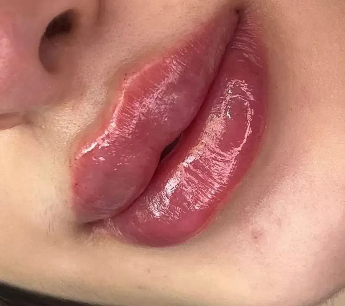 تزریق ژل و بوتاکس|خدمات آرایشگری و زیبایی|بروجرد, |دیوار