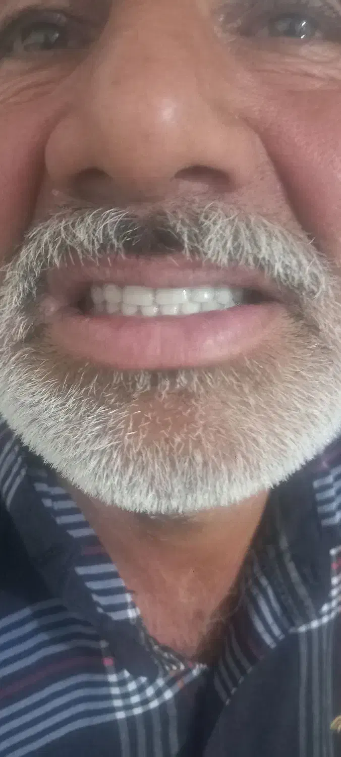 ساخت عنواع دندان مصنوعی ایرانی وخارجی|خدمات آرایشگری و زیبایی|آشخانه, |دیوار