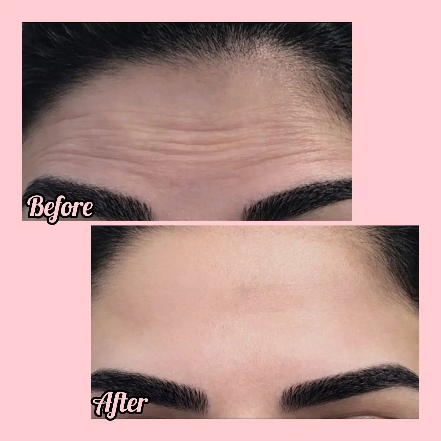 ژل بوتاکس|خدمات آرایشگری و زیبایی|سبزوار, امیر کبیر|دیوار