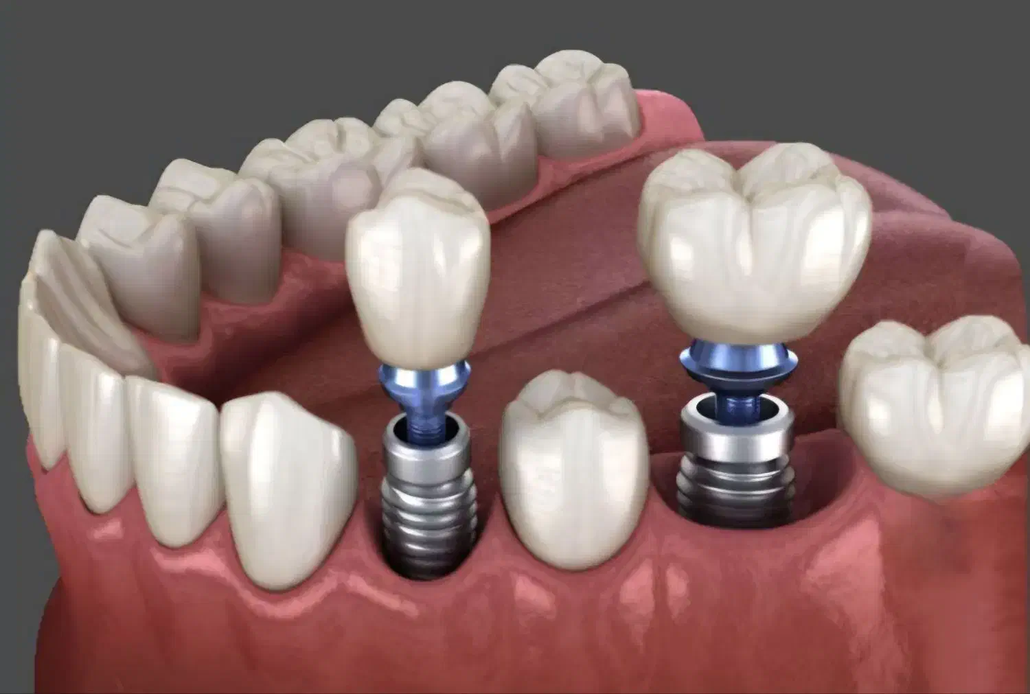 ایمپلنت فوری دیجیتال|پزشکی|کرمان, |دیوار