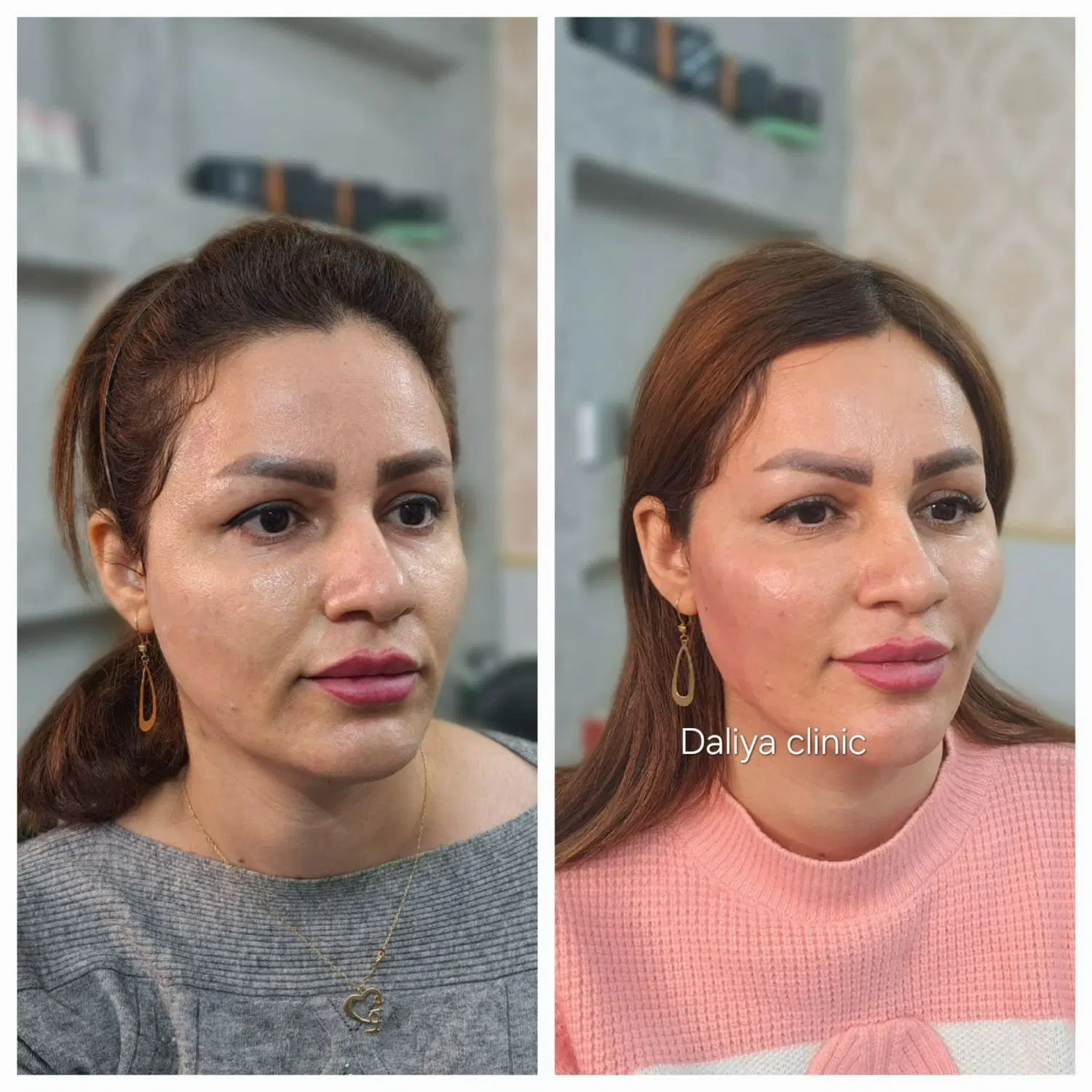 جشنواری تخفیفی کلینیک زیبایی دالیا (فیلر و بوتاکس)|خدمات زیبایی و سلامت|تهران, فدک|دیوار