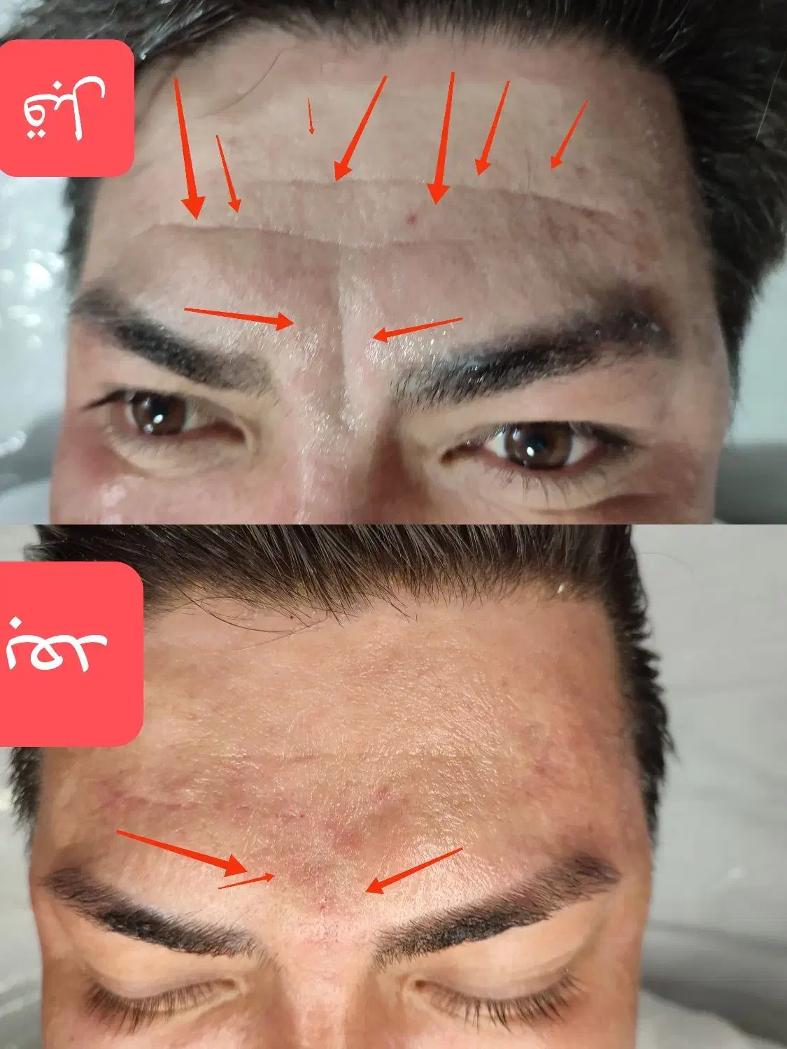 لیزر خال /میخچه زگیل/ ژل بوتاکس|خدمات آرایشگری و زیبایی|قم, صفائیه|دیوار