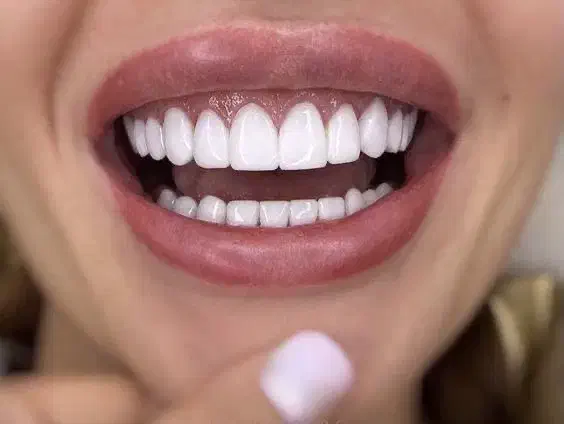 ایمپلنت ،ارتودنسی ،زیبایی با وام و اقساط ۱۵ ماهه|خدمات آرایشگری و زیبایی|آذرشهر, |دیوار