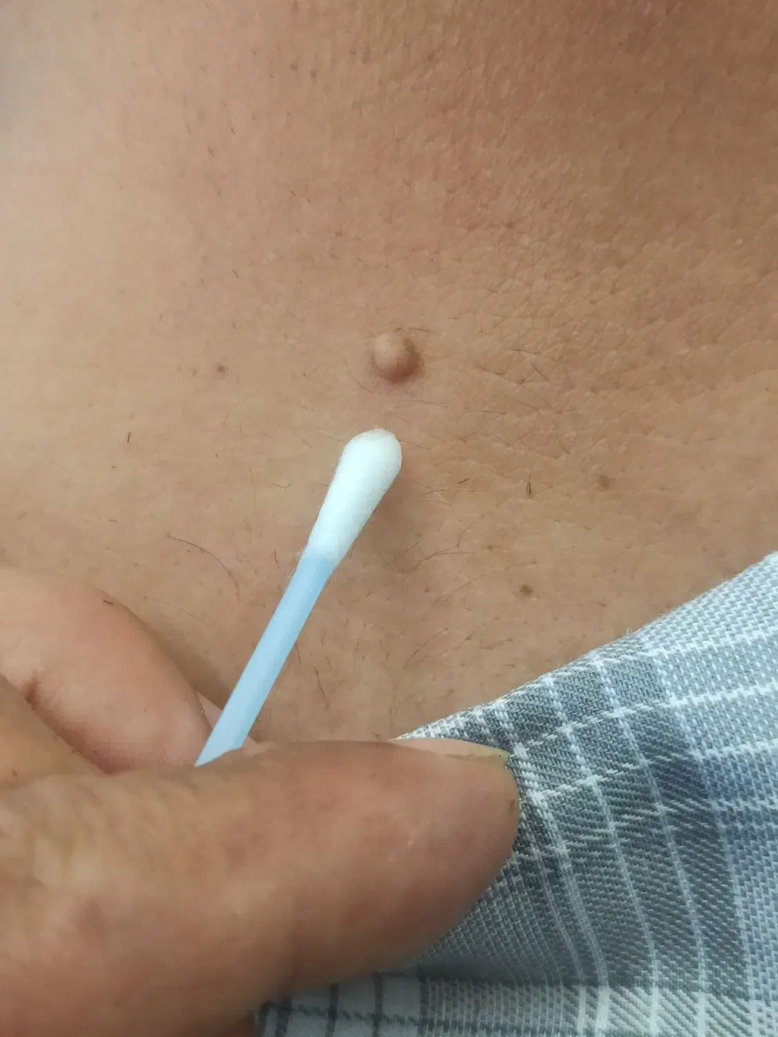 برداشت خال بالیزر بدون خون ریزی در یک جلسه|خدمات آرایشگری و زیبایی|ایلام, |دیوار