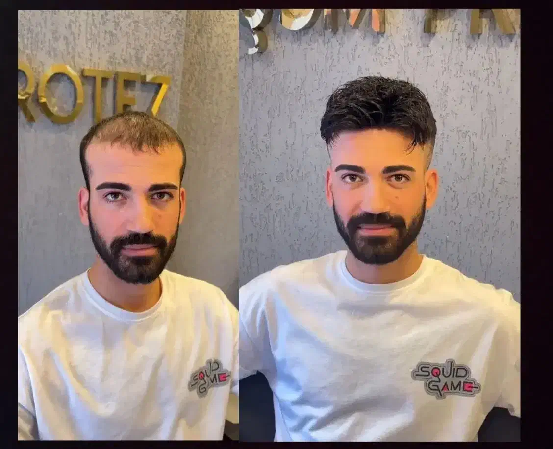 پروتز مو  سنندج|خدمات آرایشگری و زیبایی|سنندج, |دیوار