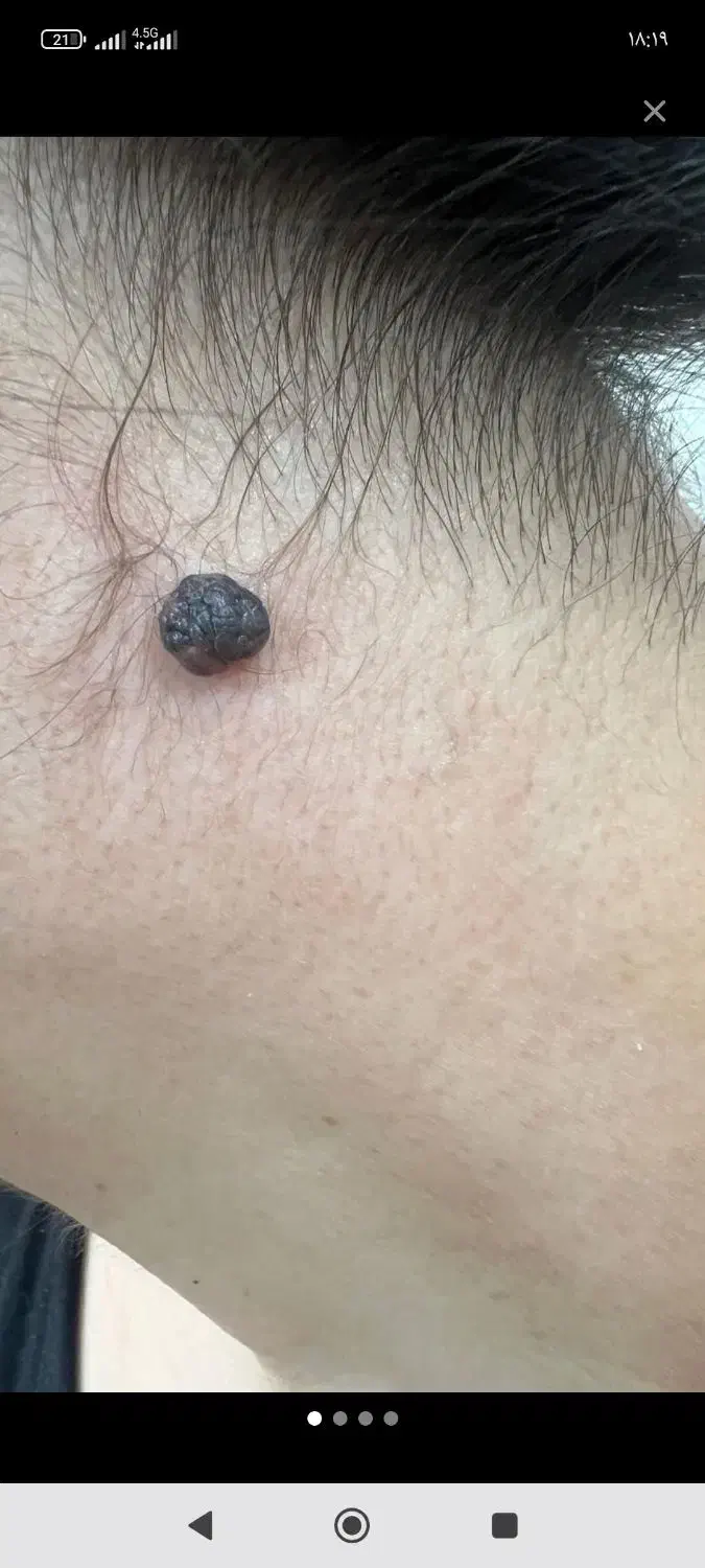 خال برداری|خدمات آرایشگری و زیبایی|قم, امامزاده ابراهیم|دیوار