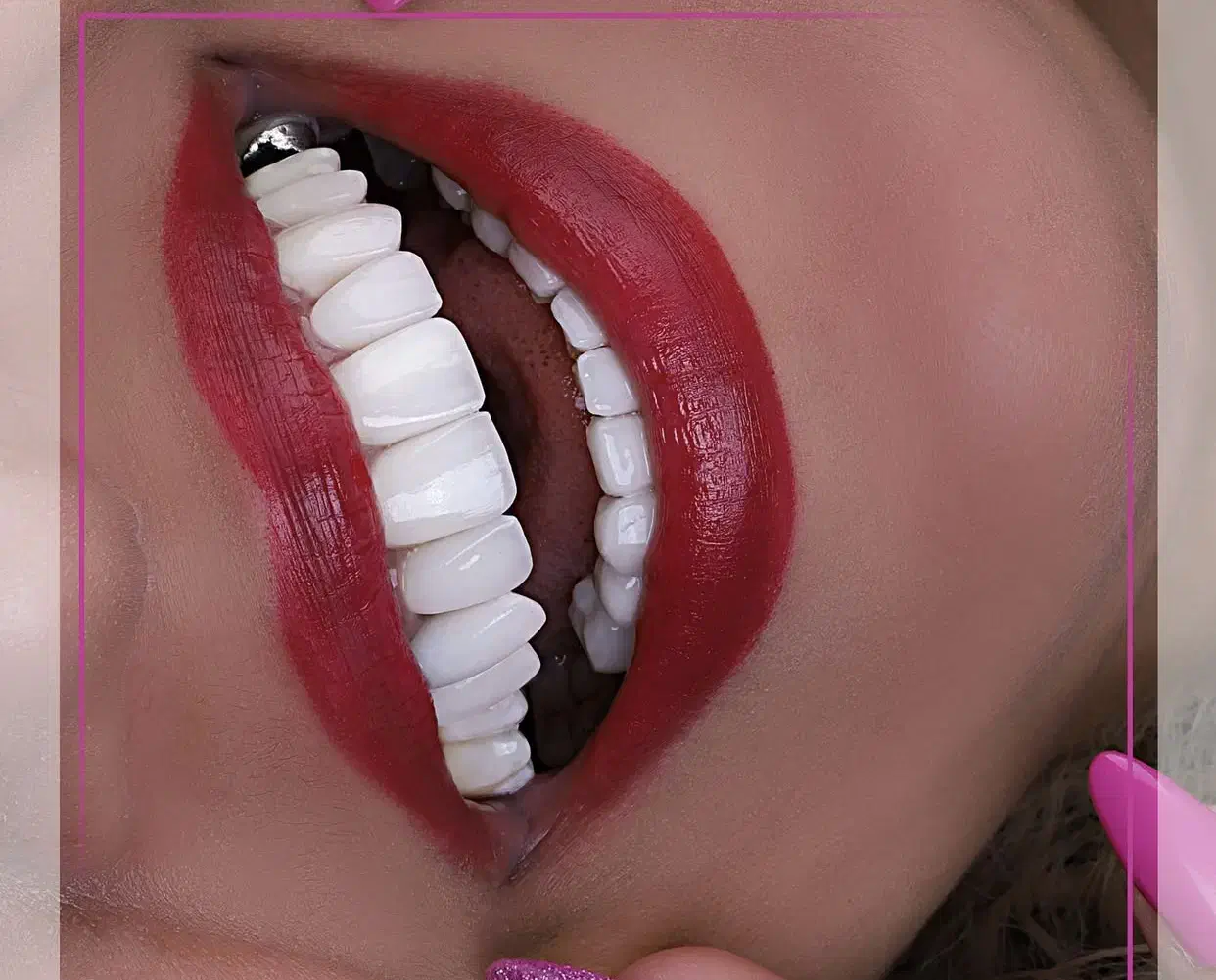 ایمپلنت بلندمدت/کامپوزیت/لمینت/درمانی|خدمات آرایشگری و زیبایی|مرند, |دیوار