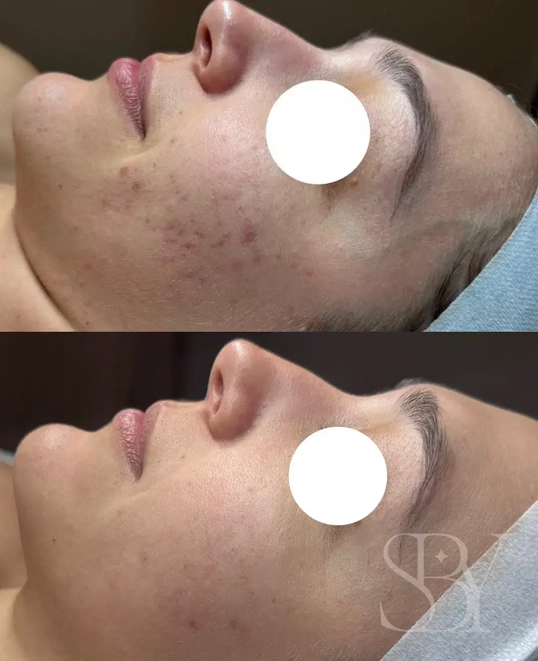 فشیال درمانی‌ رفع ۷۰ درصد اختللات پوستی|خدمات آرایشگری و زیبایی|رشت, دیلمان|دیوار