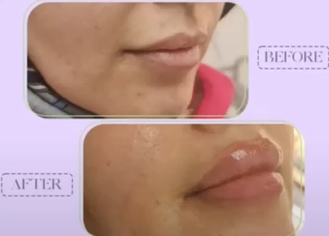 جشنواره عیدانه تزریق ژل و بوتاکس و لاغری در کلینیک|خدمات زیبایی و سلامت|تبریز, |دیوار