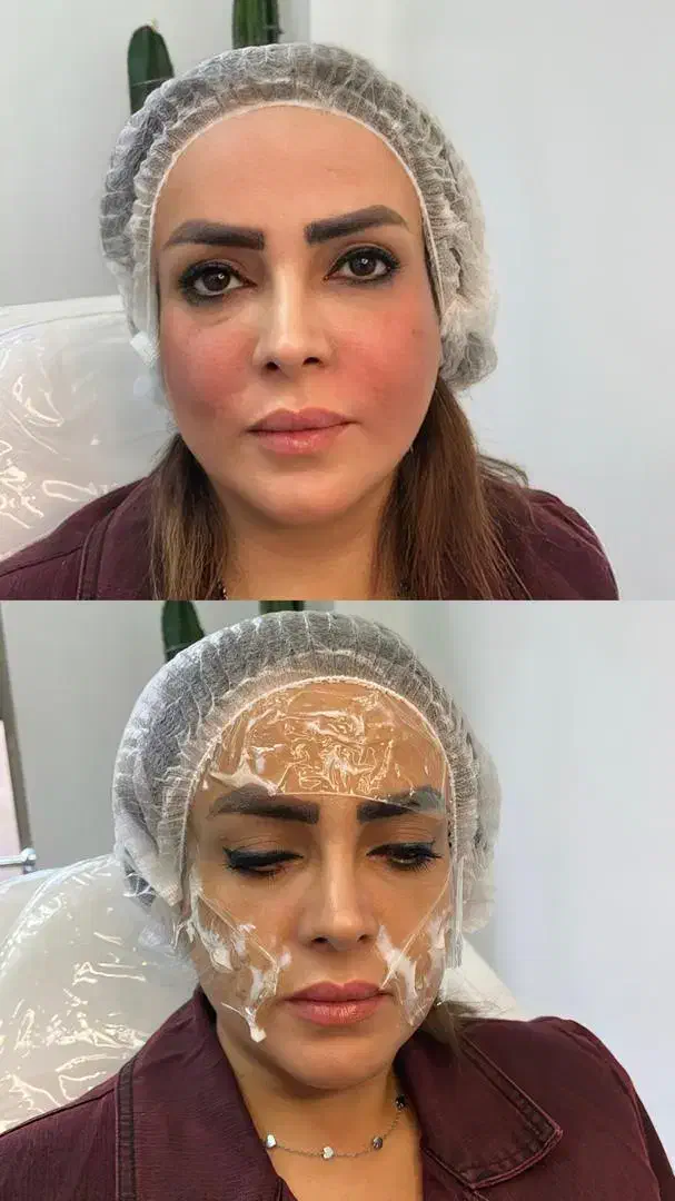 تخفیفات بلک فرایدی تزریق فیلر و بوتاکس رایگان|خدمات آرایشگری و زیبایی|ساری, |دیوار