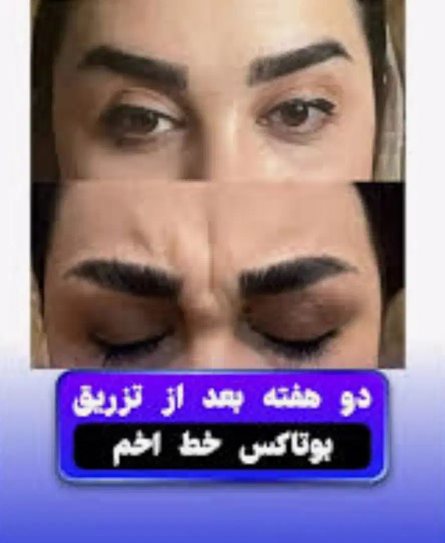 پروتوکین تراپی تخفیف ویژه روز دانشجو|خدمات آرایشگری و زیبایی|زاهدان, |دیوار