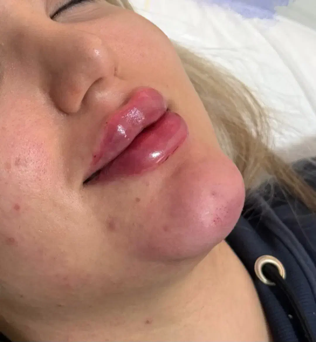 آف تزریق ژل وبوتاکس ومزومووصورت|خدمات آرایشگری و زیبایی|اهواز, نادری|دیوار