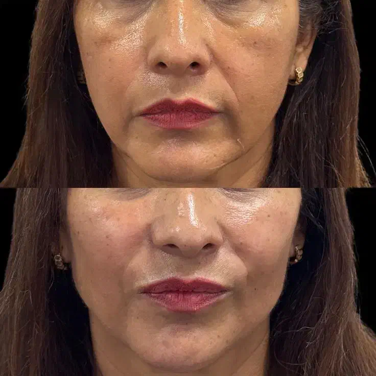 تزریق چربی جوانساز|خدمات آرایشگری و زیبایی|رفسنجان, |دیوار