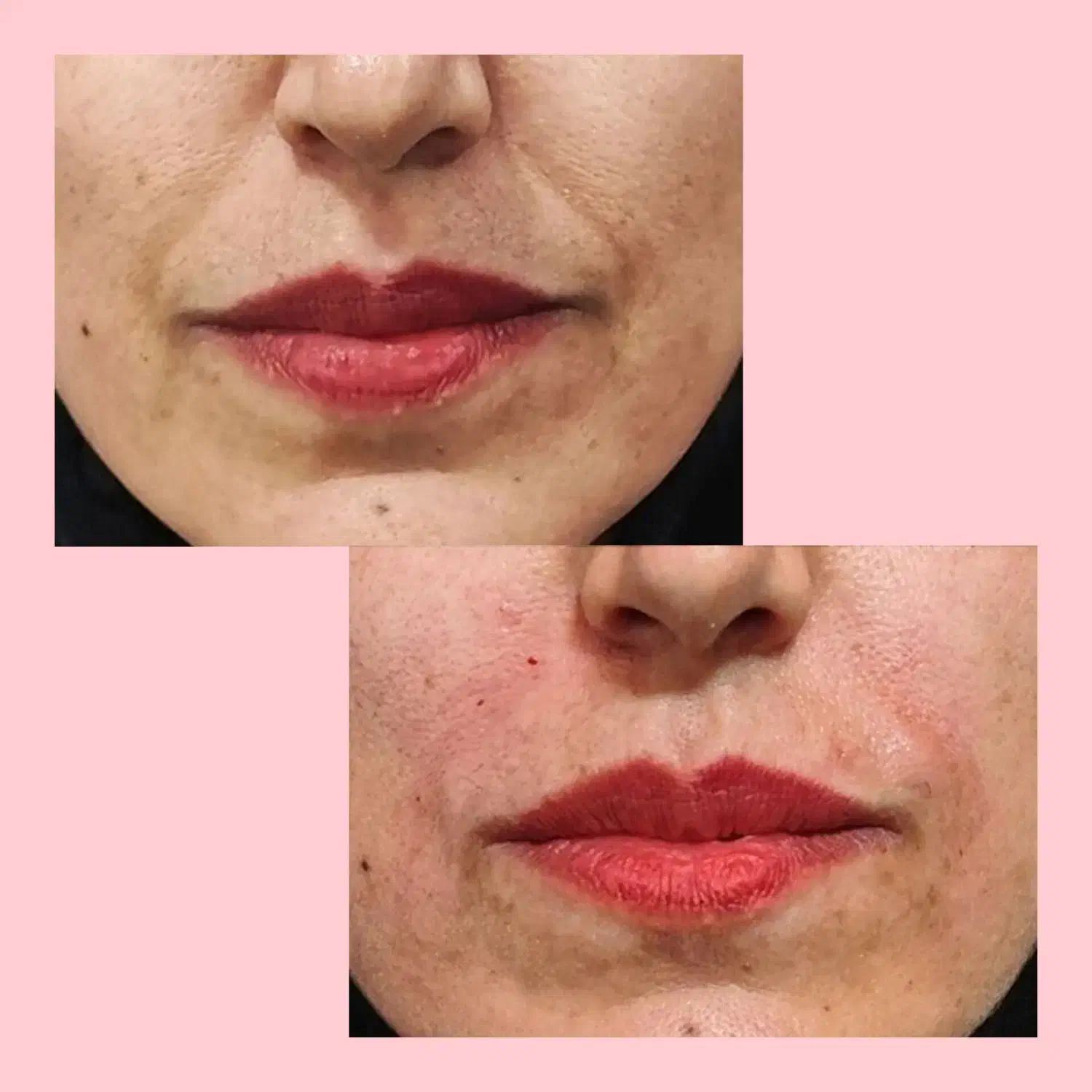 ژل بوتاکس|خدمات آرایشگری و زیبایی|سبزوار, امیر کبیر|دیوار