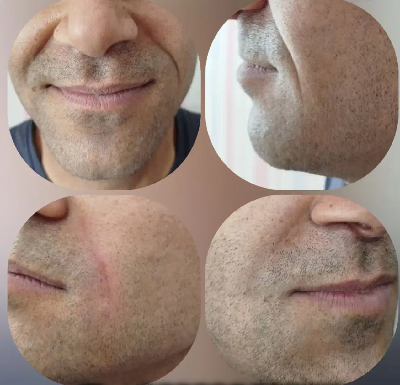 ژل و بوتاکس با ماندگاری بالا و قیمت ویژه|خدمات آرایشگری و زیبایی|شاهین‌شهر, شهرک گلدیس|دیوار