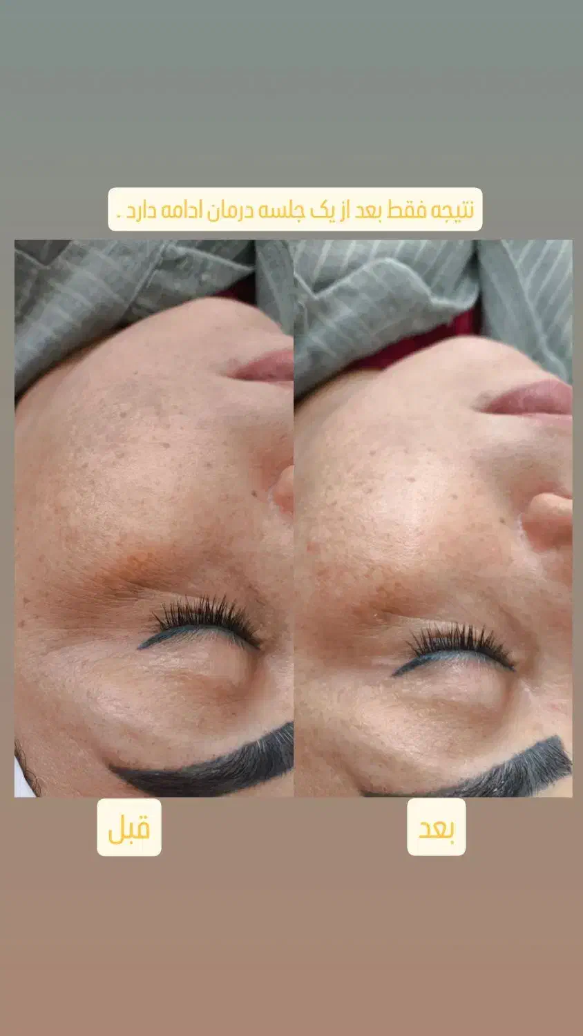 پاکسازی صورت|خدمات آرایشگری و زیبایی|زنجان, |دیوار