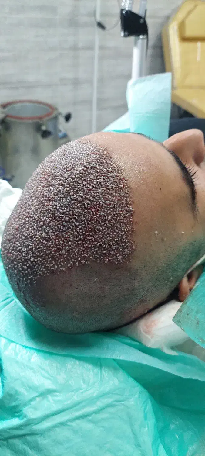 تخفیف ویژه کاشت مو و ابرو|خدمات آرایشگری و زیبایی|کرمانشاه, |دیوار