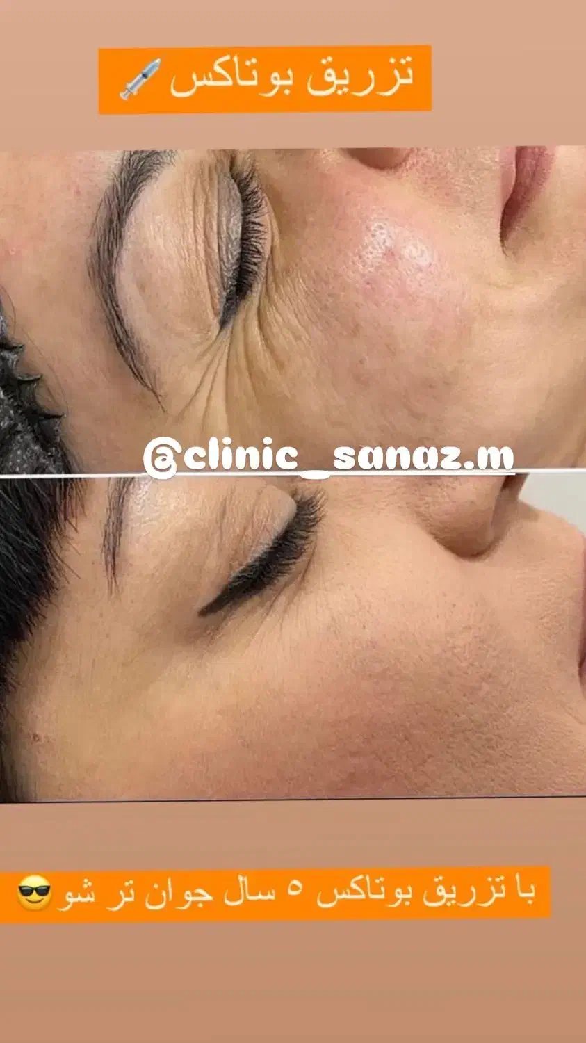 تخفیف ویژه ژل وبوتاکس|خدمات آرایشگری و زیبایی|ایذه, |دیوار