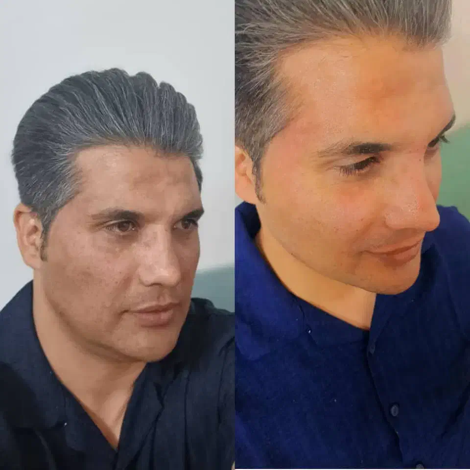 اموزش و خدمات بوتاکس و فیلروفیشیال و فیلر بادی|خدمات آرایشگری و زیبایی|شیراز, کوشک میدان|دیوار