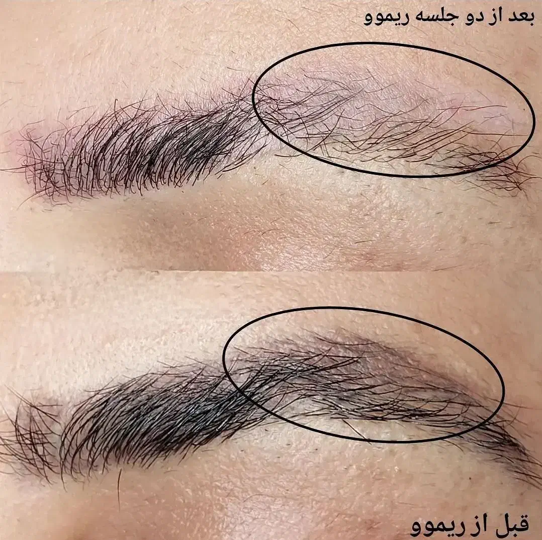 ریموور تتوهای قدیمی و تیره|خدمات آرایشگری و زیبایی|بندر کنگان, |دیوار