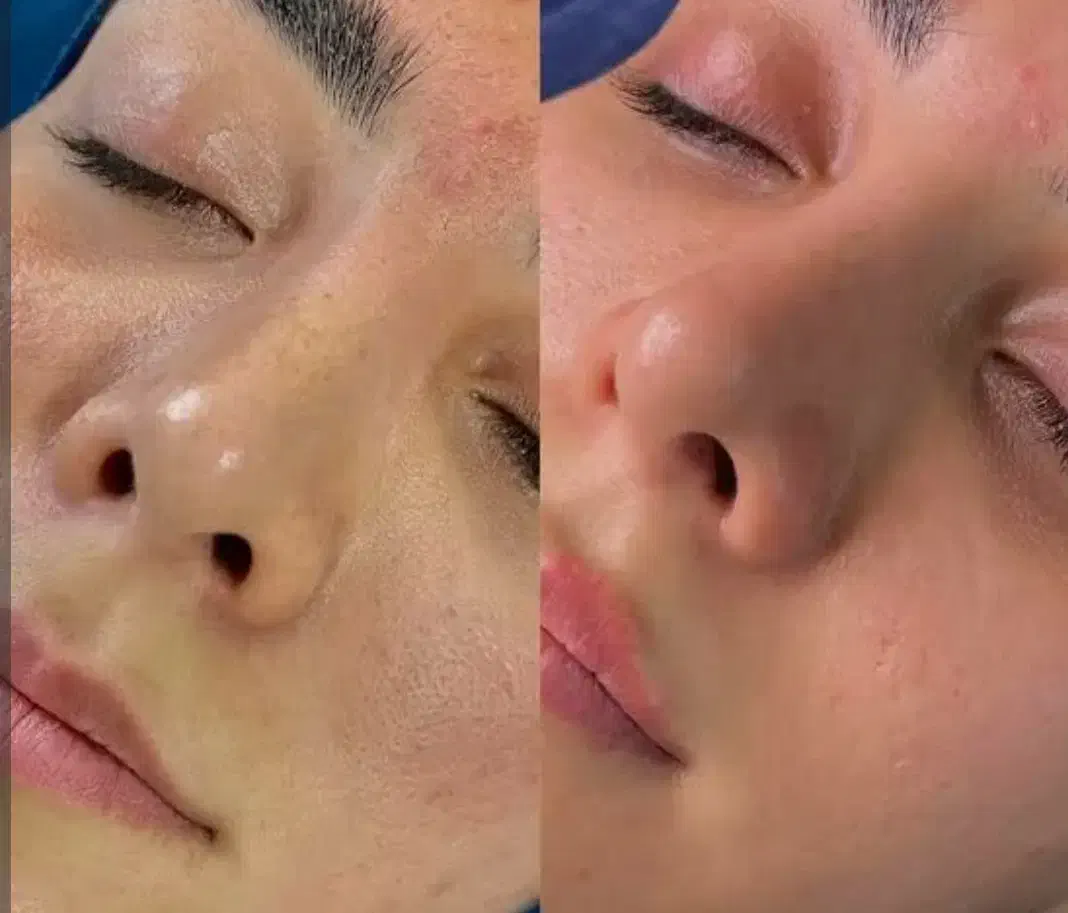 پاکسازی صورت درماپلینگ بابهترین مواد|خدمات آرایشگری و زیبایی|بیرجند, |دیوار