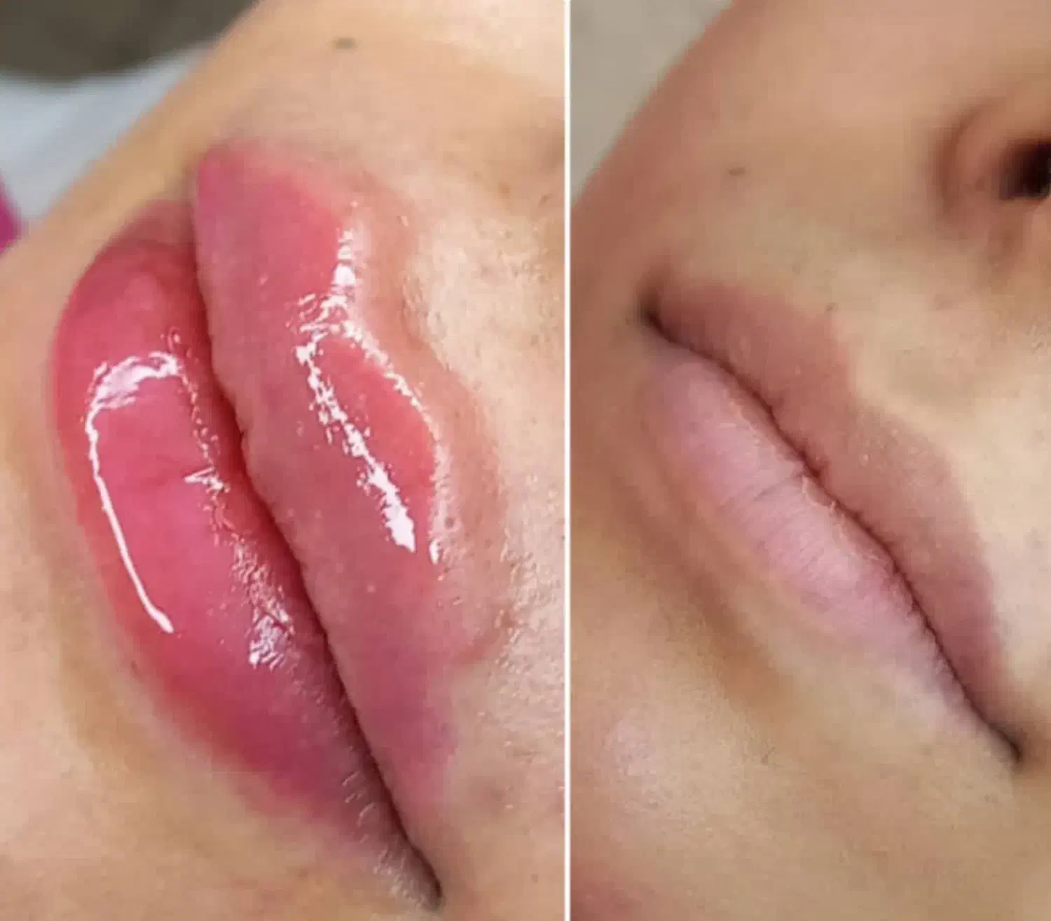 جشنواره ی تزریق بوتاکس و ژل و جوانسازها (هایفو،RF)|خدمات آرایشگری و زیبایی|تهران, نیلوفر|دیوار