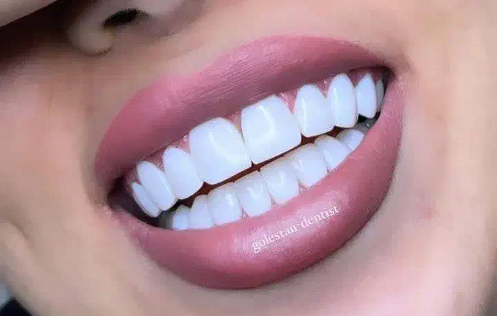 خدمات کامپوزیت،روکش،دندان مصنوعی|خدمات آرایشگری و زیبایی|چهاردانگه (تهران), |دیوار