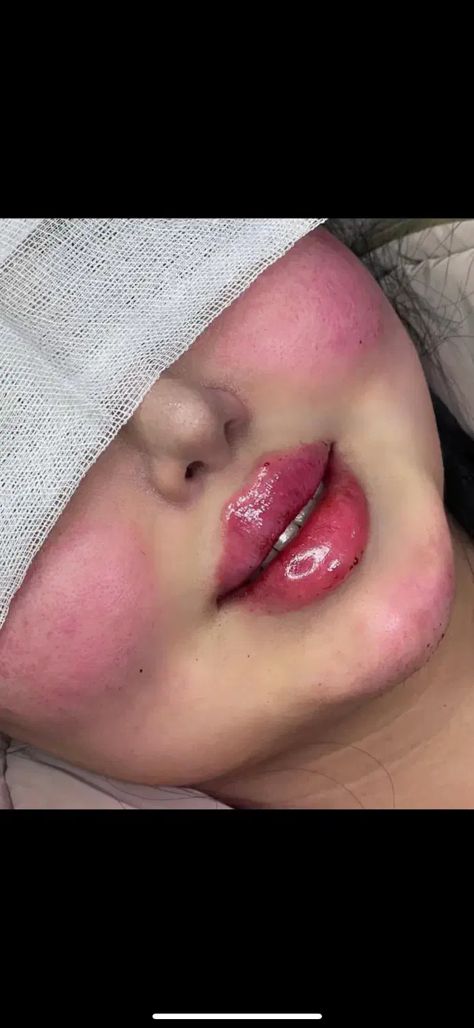 تزریقات ژل و بوتاکس|خدمات آرایشگری و زیبایی|گرگان, |دیوار