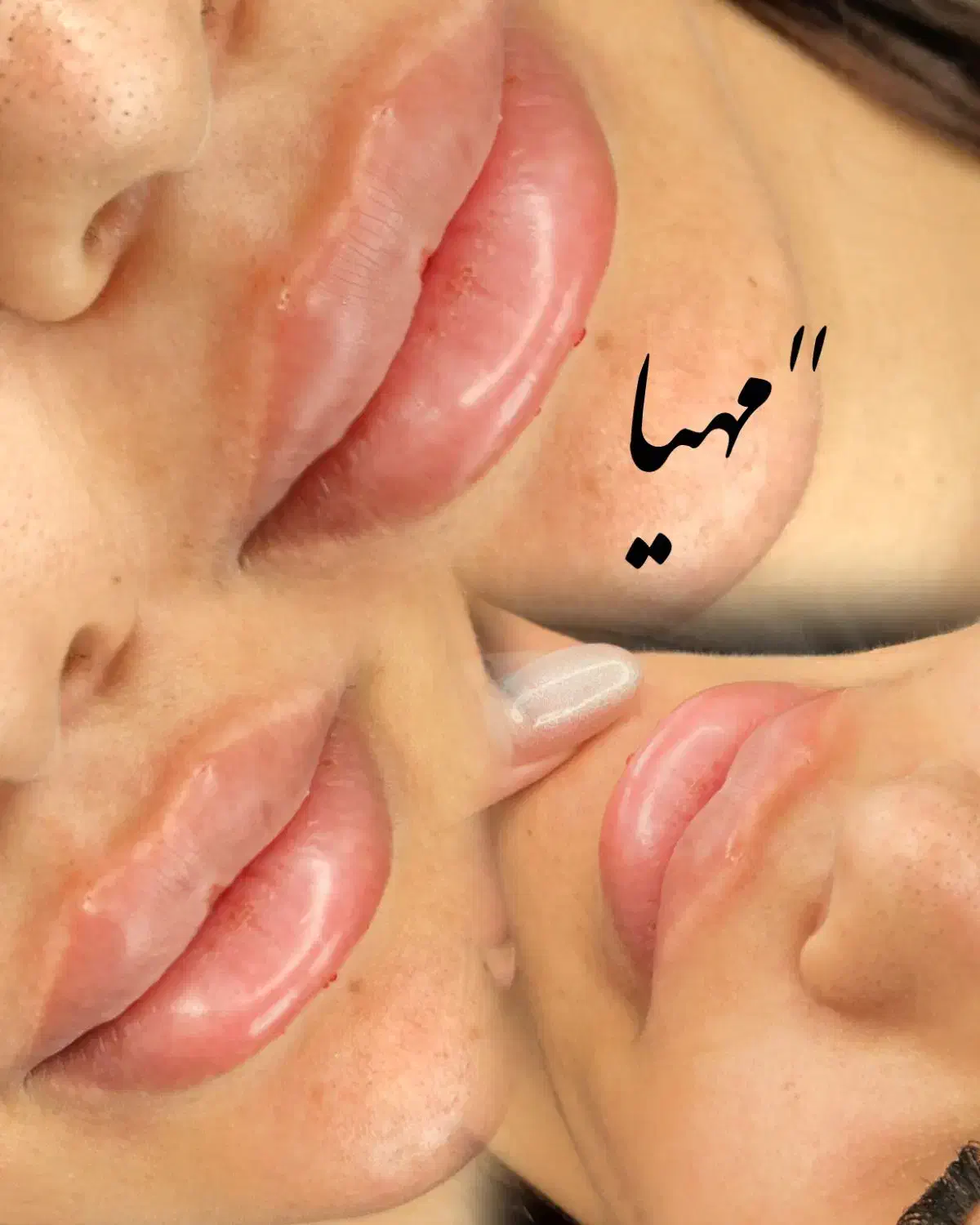 فیلر و بوتاکس وانزیم فیلر|خدمات آرایشگری و زیبایی|قم, دروازه چوبی|دیوار