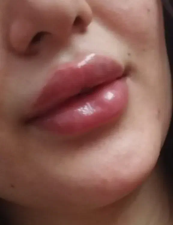 ژل ـ لب ـ گونه و... بوتاکس. آنزیم|خدمات آرایشگری و زیبایی|قم, تولید دارو و یخچال|دیوار