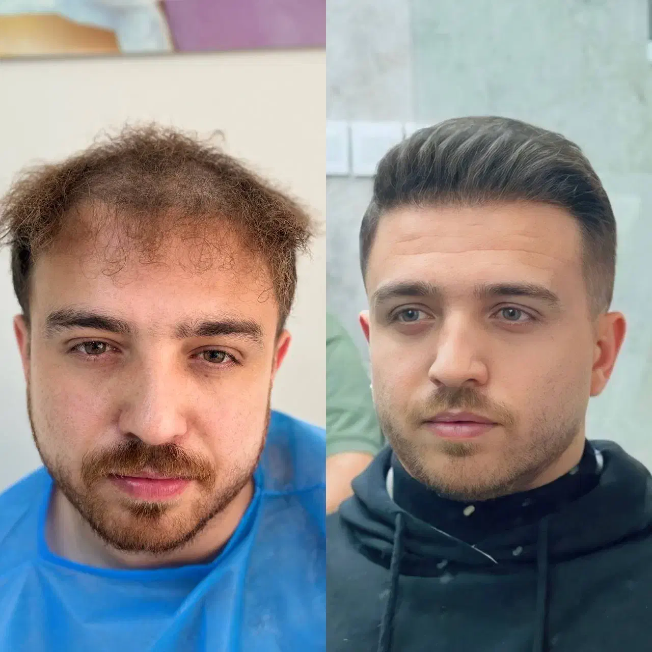 کاشت مو و ابرو.با شرایط ویژه پنچ تومن|خدمات آرایشگری و زیبایی|تبریز, |دیوار