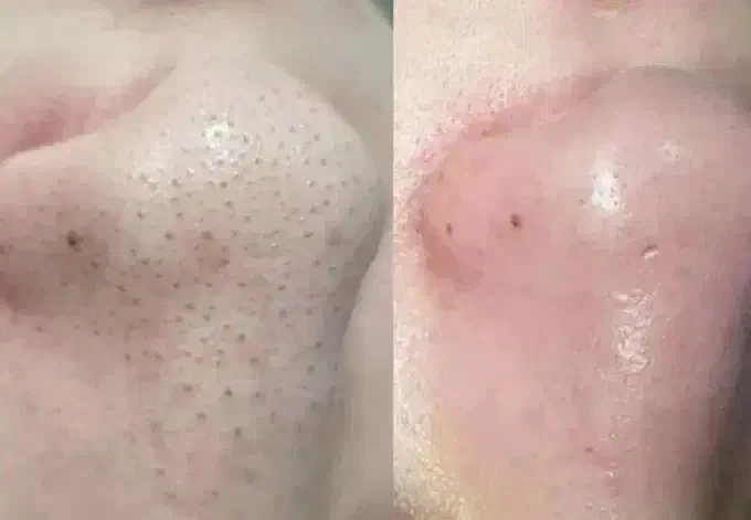 فشیال و پاکسازی صورت|خدمات آرایشگری و زیبایی|اردبیل, |دیوار