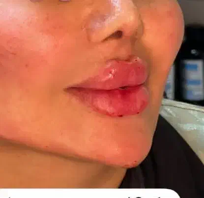 ژل لب و بوتاکس|خدمات آرایشگری و زیبایی|قائمشهر, |دیوار