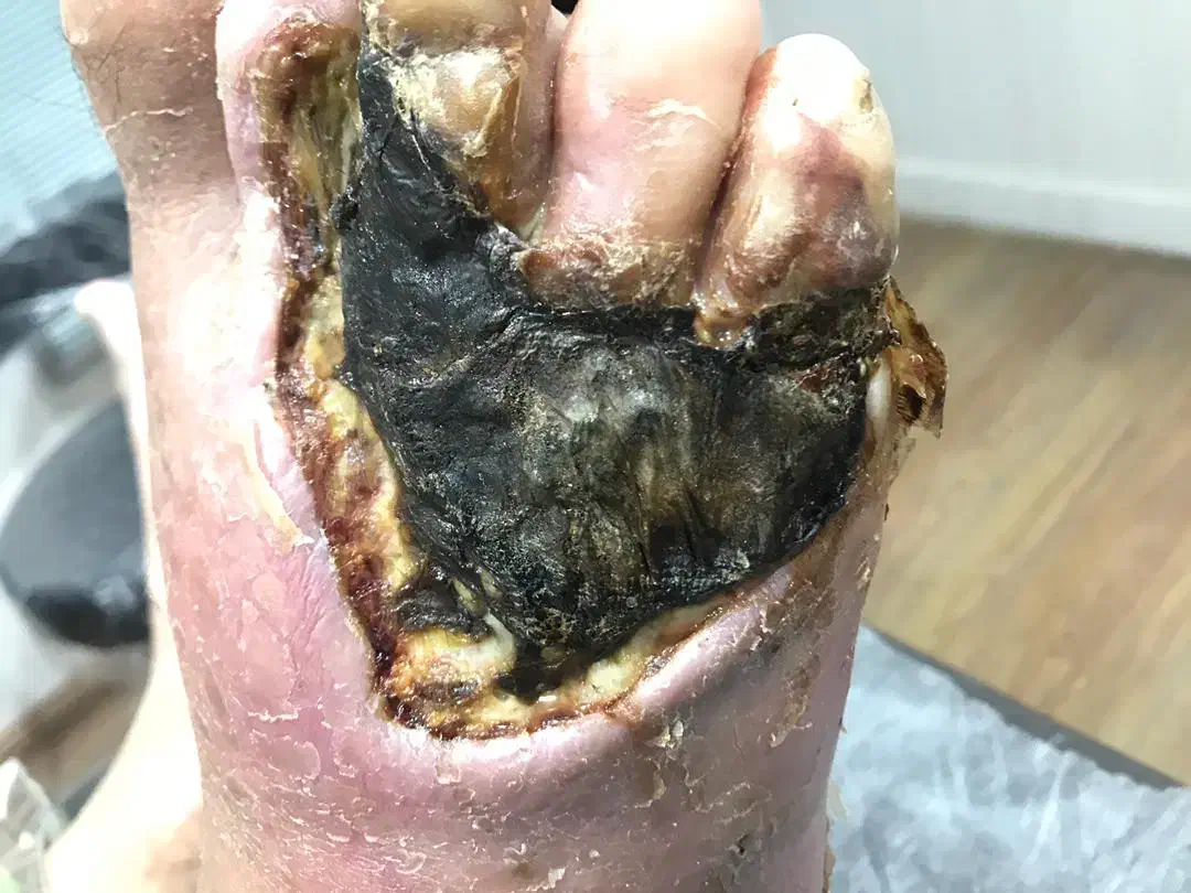 درمان انواع زخم ها با روش های بروز پزشکی|خدمات آرایشگری و زیبایی|تبریز, |دیوار