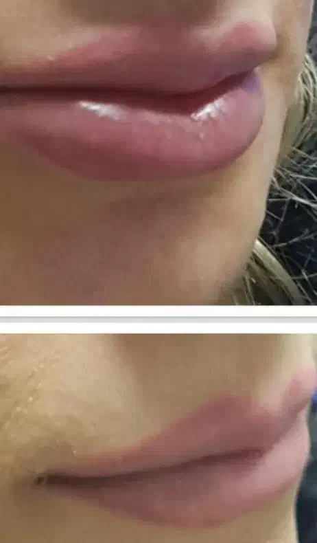ژل لب توسط پزشک با50%هزینه فقط شهریور(شعبه جدید)|خدمات آرایشگری و زیبایی|تهران, نعمت‌آباد|دیوار