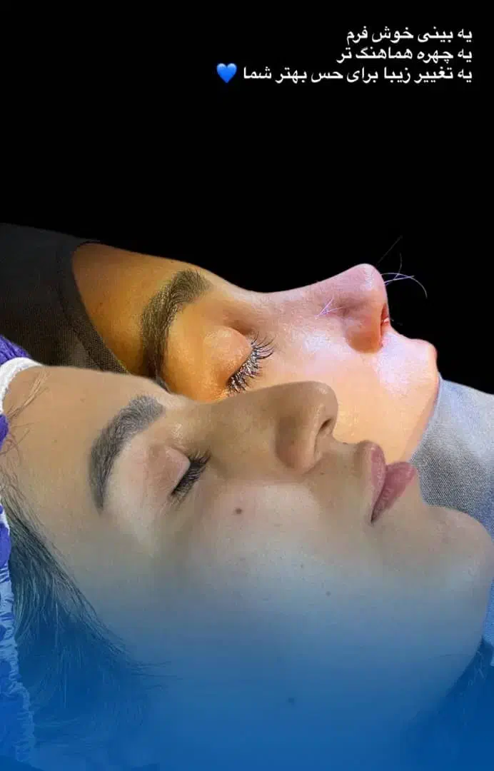 فرصت استثنایی وباورنکردنی عمل بینی بصورت اقساط|خدمات آرایشگری و زیبایی|ایذه, |دیوار