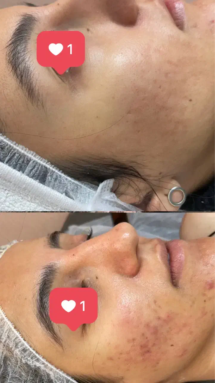 درمان قطعی لک و جوش در کوتاهترین زمان|خدمات آرایشگری و زیبایی|مشهد, چهارچشمه|دیوار