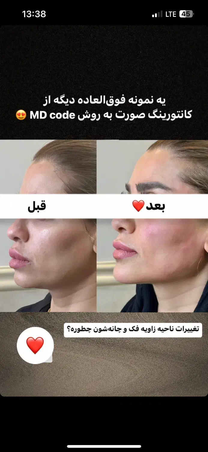 ژل و بوتاکس|خدمات آرایشگری و زیبایی|شیراز, زرهی|دیوار