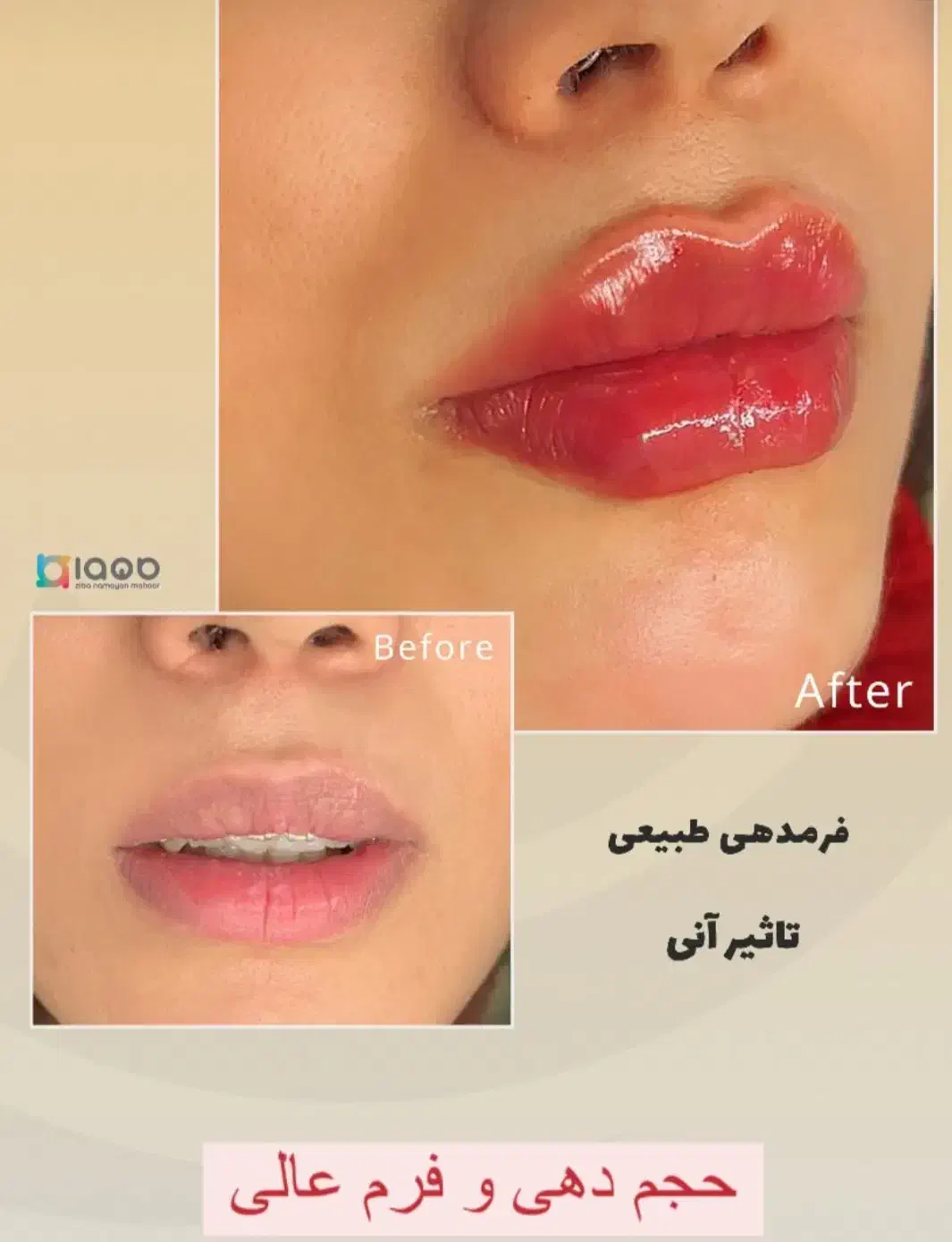 بلفاروبلاستی/کاشت مو/کاشت ابرو/کاشت ریش/عمل بینی|خدمات آرایشگری و زیبایی|همدان, |دیوار