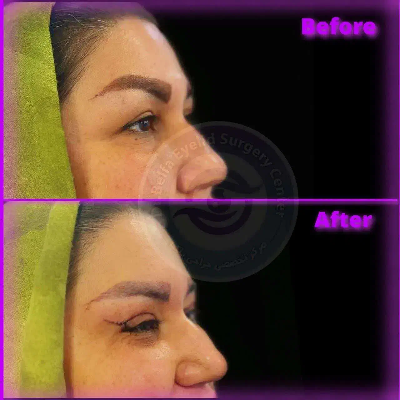 جشنواره ویژه بلفاروپلاستی(جراحی زیبایی پلک)|خدمات آرایشگری و زیبایی|بندر امام خمینی, |دیوار